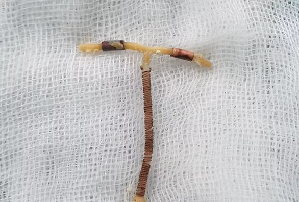 Vong tranh thai dam thung truc trang: Nhung tai nan dang so khac-Hinh-3