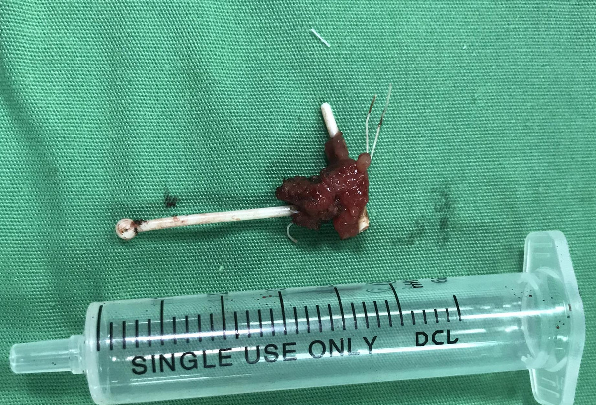 Vong tranh thai dam thung truc trang: Nhung tai nan dang so khac-Hinh-2