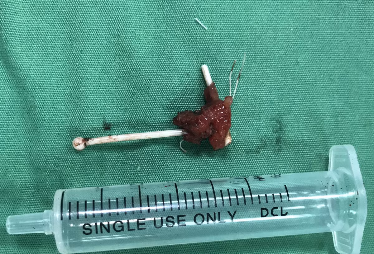 Vong tranh thai dam thung truc trang: Nhung tai nan dang so khac-Hinh-2