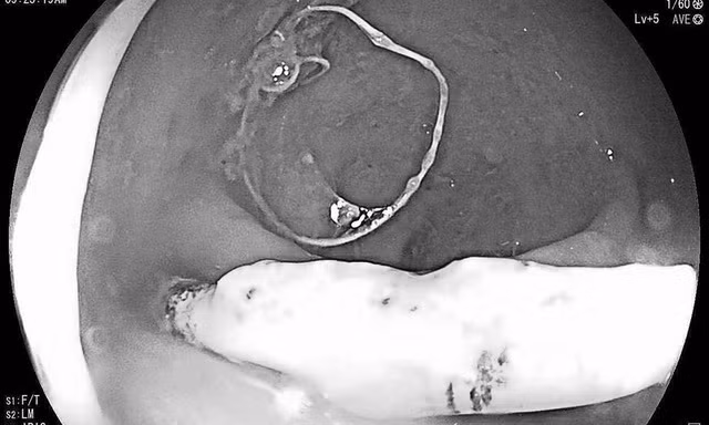 Vong tranh thai dam thung truc trang: Nhung tai nan dang so khac