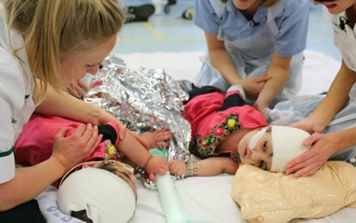 Nghet tho nhung ca phau thuat tach roi song sinh dinh lien tren the gioi