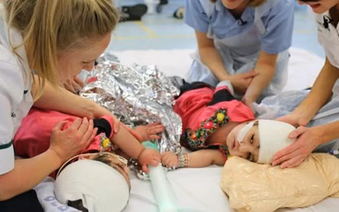 Nghet tho nhung ca phau thuat tach roi song sinh dinh lien tren the gioi