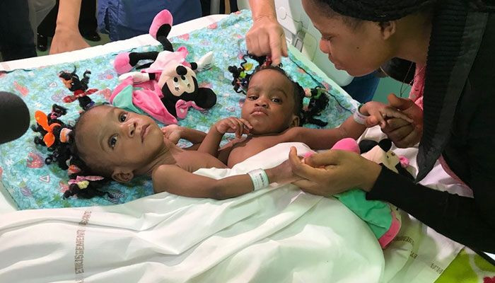 Nghet tho nhung ca phau thuat tach roi song sinh dinh lien tren the gioi-Hinh-3