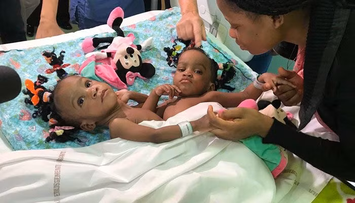 Nghet tho nhung ca phau thuat tach roi song sinh dinh lien tren the gioi-Hinh-3