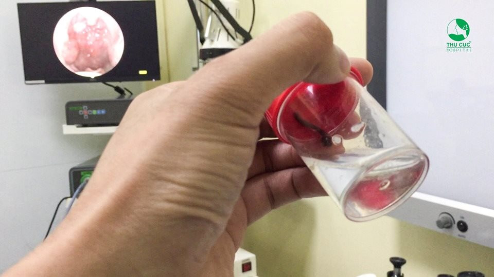 Bệnh nhân cho biết, cách đó hơn 10 ngày có đi phượt. Dù đã trang bị đầy đủ: Che mặt che tai mũi và miệng nhưng đã ghé vào khe suối hứng nước, sơ ý bỏ đồ bảo hộ và bị vắt chui vào mà không biết.