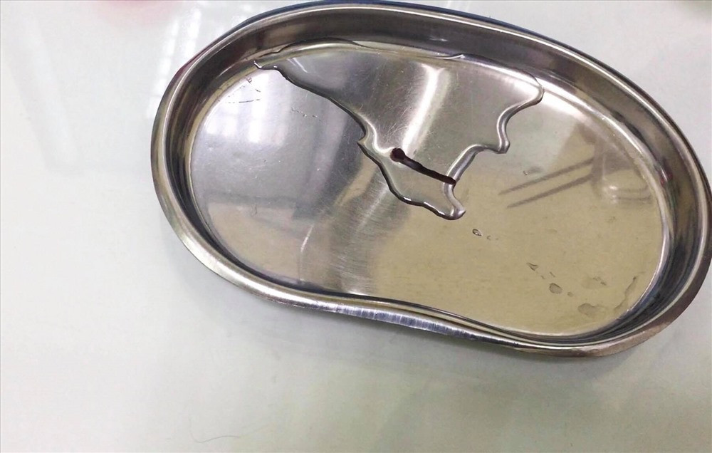 Theo lời kể của người đàn ông này, trong khoảng thời gian 2-3 tuần trước đó, ông đã lên rừng bắt ếch, bắt cua, sau một tuần về thì thấy xuất hiện những biểu hiện trên. Sợ hãi kèm lo lắng quá nhiều đến mức sụt cân nặng, cuối cùng ông mới đến bệnh viện để thăm khám và phát hiện con vắt sống trong mũi.