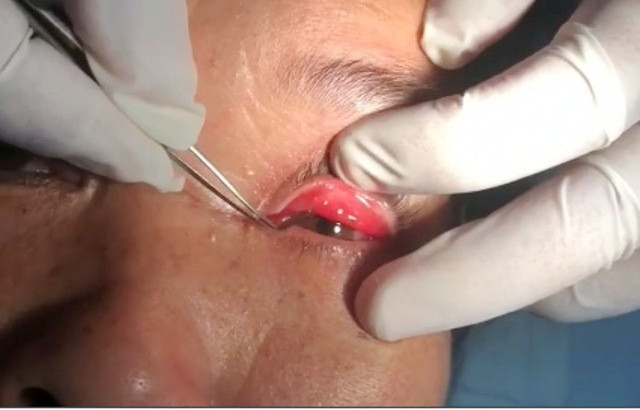 Tháng 11/2019, các bác sĩ Khoa Mắt, Bệnh viện Đa khoa Nông nghiệp (Hà Nội) vừa thực hiện gắp thành công con vắt trong mắt của một nữ bệnh nhân. Đó là trường hợp của bà Cao Thị H. (50 tuổi, quê ở huyện Quan Hóa, tỉnh Thanh Hóa). Ngày 13/11, bệnh nhân đến khám với lý do bị con vắt chui vào mắt.