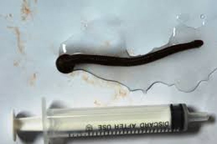 Tháng 8/2016, các bác sĩ BV Đa khoa Lào Cai đã gắp ra 1 con vắt khoảng 5-6 cm sống nhiều ngày trong cổ họng bệnh nhi 6 tuổi mà nguyên nhân có thể do trước đó bé trai này uống nước suối rừng. Ảnh: Internet. Video "Dầu thực vật có thực sự tốt cho sức khỏe?". Nguồn: VTC.