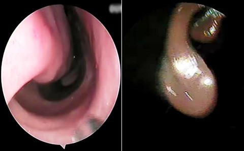 Ngày 30/5/2018, Trung tâm y tế huyện Quế Phong (Nghệ An), cho biết các bác sĩ đã gắp thành công hai con vắt dài 7cm và 3cm sống trong mũi hai bệnh nhi Vi Quốc Tiến (8 tuổi, ở xã Cắm Muộm) và Ngân Thị Bính (73 tuổi, trú xã Nậm Giải).