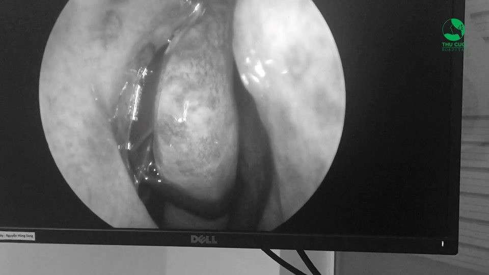 Trước đó, hồi tháng 10 năm ngoái, bệnh nhân Nguyễn Hoàng H. (38 tuổi, Cầu Giấy, Hà Nội) đi khám tại Bệnh viện Đa khoa Quốc tế Thu Cúc khi bị hắt hơi, ngạt mũi, nước mũi có máu và ho nhẹ. Kết quả nội soi tai cuốn mũi bị sung huyết, khe giữa mũi phải có dị vật sống đang “ngoe nguẩy” bên trong cuốn mũi.