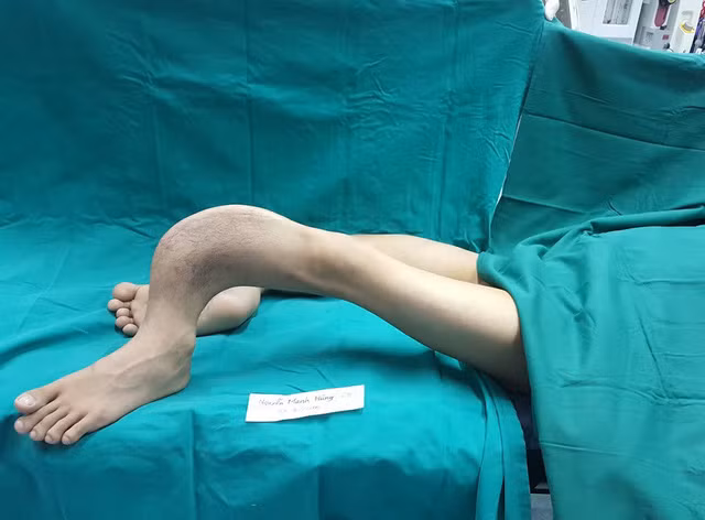 Ky tich y khoa Viet Nam: Ngoai phi cong nguoi Anh... con gi nua?-Hinh-5