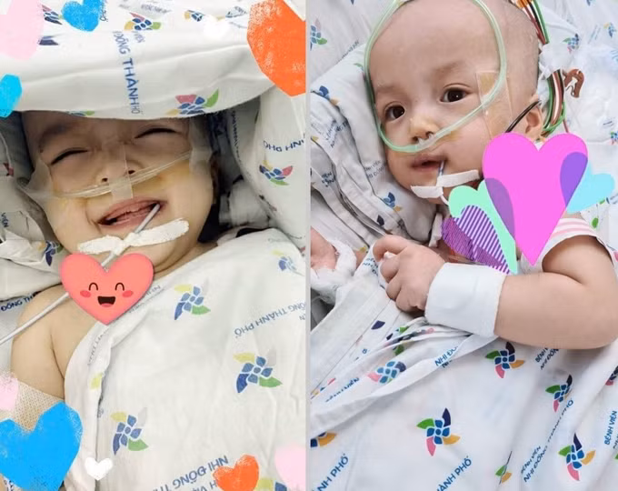 Sau cai thở máy, Trúc Nhi rất tỉnh và hoạt bát. Bé dung nạp tốt lượng sữa tập ăn, tiêu hóa ổn. Mỗi cữ sữa, bé uống được 20-40 ml. Ảnh: Lan Anh Nguyen