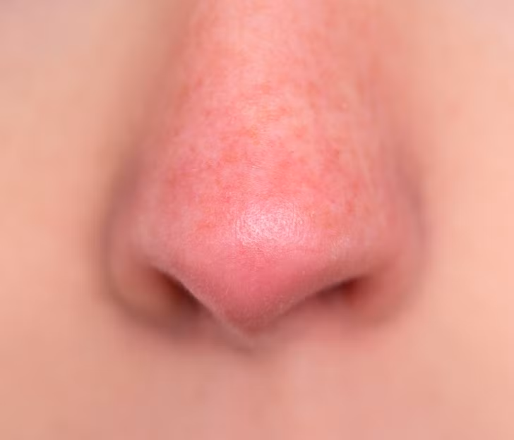 6 dieu can biet truoc khi dung mieng lot mun dau den-Hinh-3