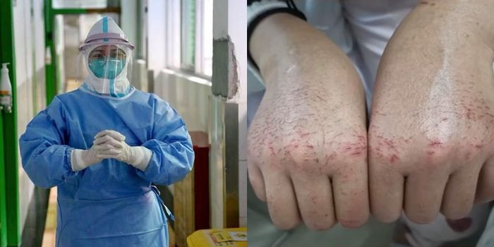 Bàn tay của một y tá nứt nẻ vì tiếp xúc nhiều với thuốc sát khuẩn. Video "3 người từ ổ dịch virus corona bị sốt tại Việt Nam". Nguồn: VTC.