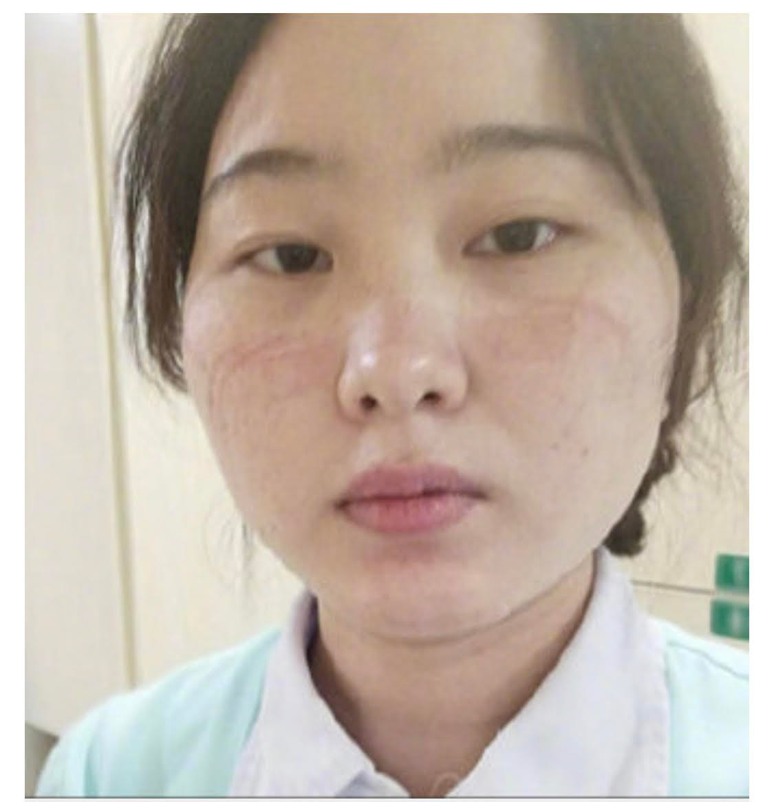 Không chỉ cắt tóc, họ còn phải cạo tóc quanh gáy để mang đồ bảo hộ tránh lây nhiễm.