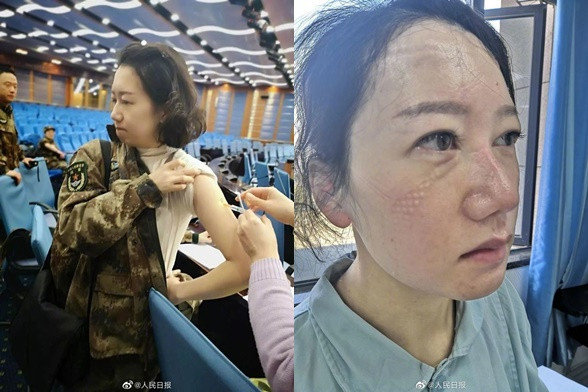 Lưu Lệ, y tá trưởng của khoa gan mật bệnh viện Tây Nam, một thành viên thuộc đội ngũ điều trị của Đại học Lục quân Quân y, khiến dân mạng xứ Trung cảm động vì gương mặt tiều tụy, hằn vết khẩu trang bảo hộ sau nhiều ngày làm việc tại tâm dịch Vũ Hán.