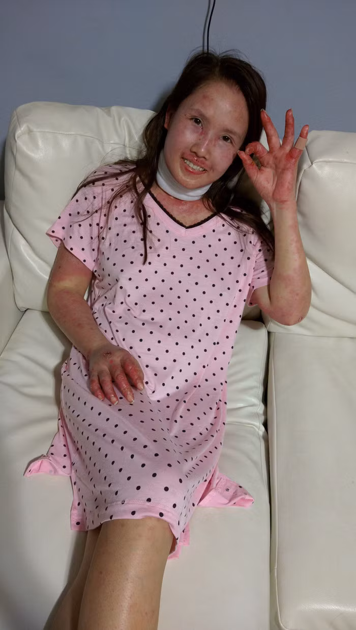 Me bim sua “chet di song lai” voi can benh lupus ban do khi mang thai-Hinh-4