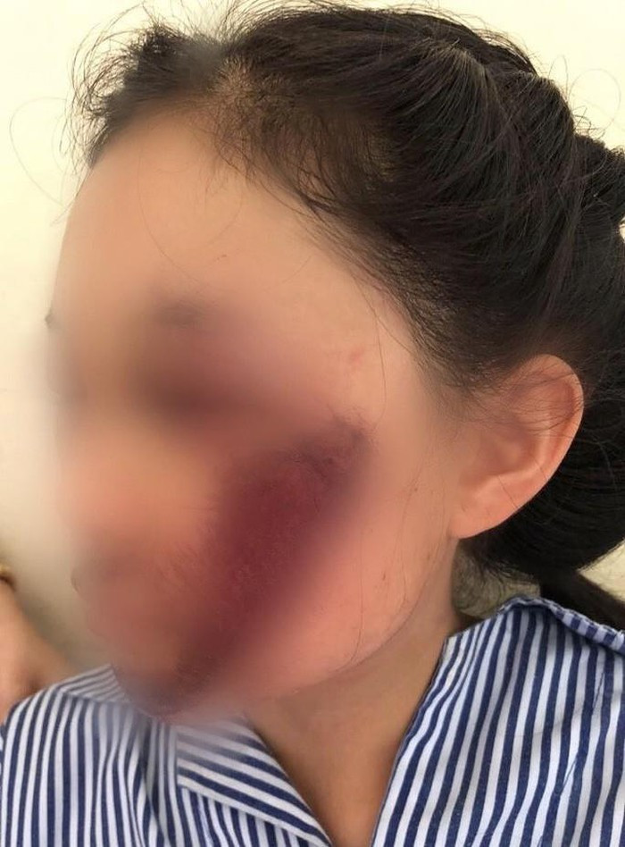 Ao chong nang cuon vao banh xe, nu sinh ton thuong mat nghiem trong