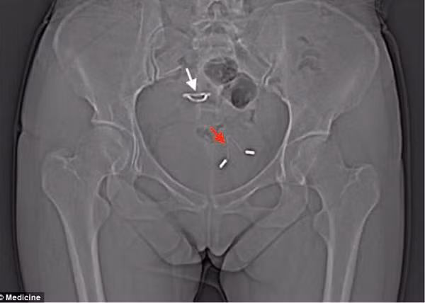 Bé trai “đội” vòng tránh thai: Seri chuyện ly kỳ về chị em tránh thai... - Hình 5 Be trai “doi” vong tranh thai: Seri chuyen ly ky ve chi em tranh thai...-Hinh-5
