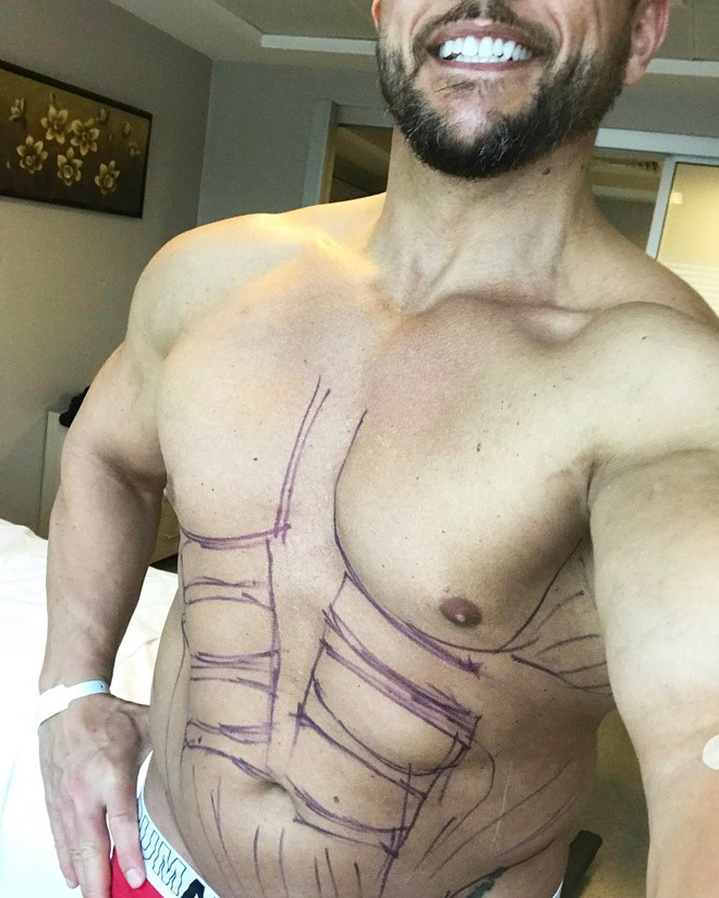 Trong khi đó, tạo hình bụng 6 múi mang lại cho Adam Baroni và các chàng trai cơ thể săn chắc mà không cần tập luyện, ăn uống kiêng kem. Bác sĩ thẩm mỹ sẽ hút hết mỡ bụng, sau đó dùng máy móc khiến da co rút đi làm các múi cơ hiện rõ hơn.