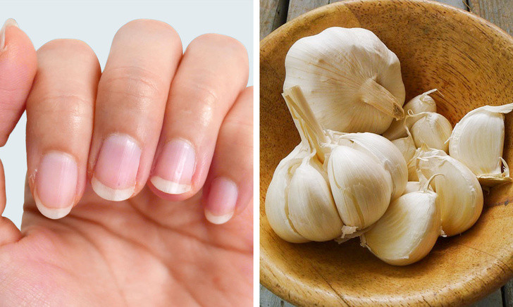 Tỏi cũng chứa nhiều thành phần có tính kháng khuẩn, ngăn vi khuẩn, nấm phát triển. Hãy nghiền nát vài tép tỏi tươi sau đó đặt chúng lên vùng móng nhiễm nấm. Kiên trì với cách này hàng ngày sẽ giúp vùng khóe móng nhanh phục hồi, khỏe mạnh trở lại. Ảnh: BS. Video "Bí quyết làm đẹp của sao Việt". Nguồn: VTC.