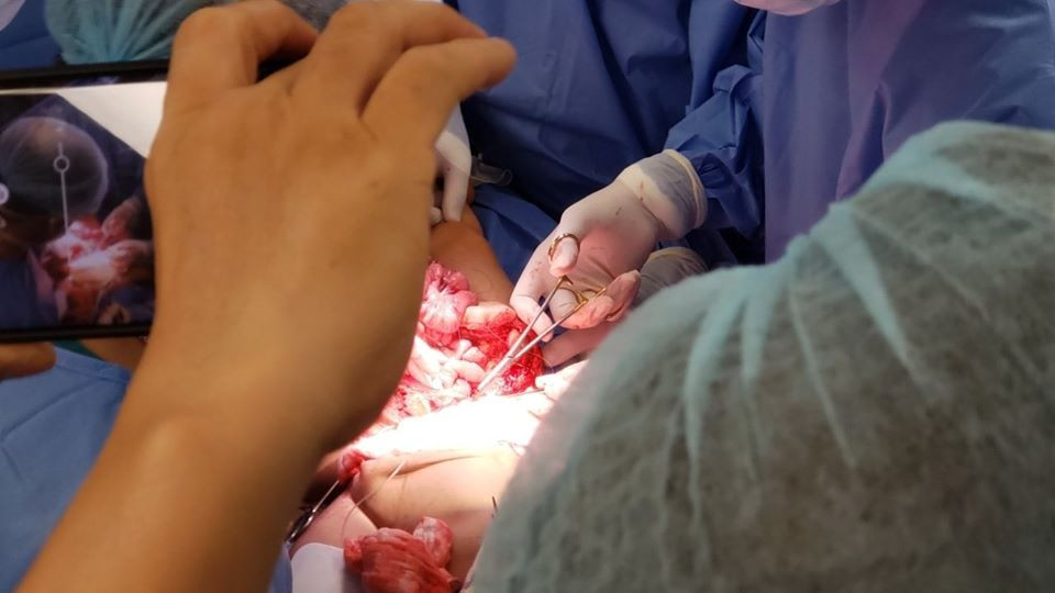 Ca mổ đang diễn ra đúng với dự liệu kế hoạch trước phẫu thuật. Trước đó, khoảng 12h30, ê-kíp chỉnh hình thay ê-kíp phẫu thuật niệu. Đội ngũ y bác sĩ bước vào phần quan trọng là tách phần xương, tiến hành tách rời cặp song sinh và chuyển 2 phòng mổ khác với 2 ekip đang chuẩn bị. Sinh hiệu 2 bé hoàn toàn ổn định đến thời điểm này.