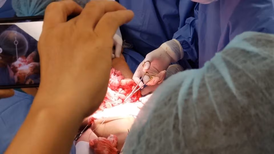 Ca mổ đang diễn ra đúng với dự liệu kế hoạch trước phẫu thuật. Trước đó, khoảng 12h30, ê-kíp chỉnh hình thay ê-kíp phẫu thuật niệu. Đội ngũ y bác sĩ bước vào phần quan trọng là tách phần xương, tiến hành tách rời cặp song sinh và chuyển 2 phòng mổ khác với 2 ekip đang chuẩn bị. Sinh hiệu 2 bé hoàn toàn ổn định đến thời điểm này.