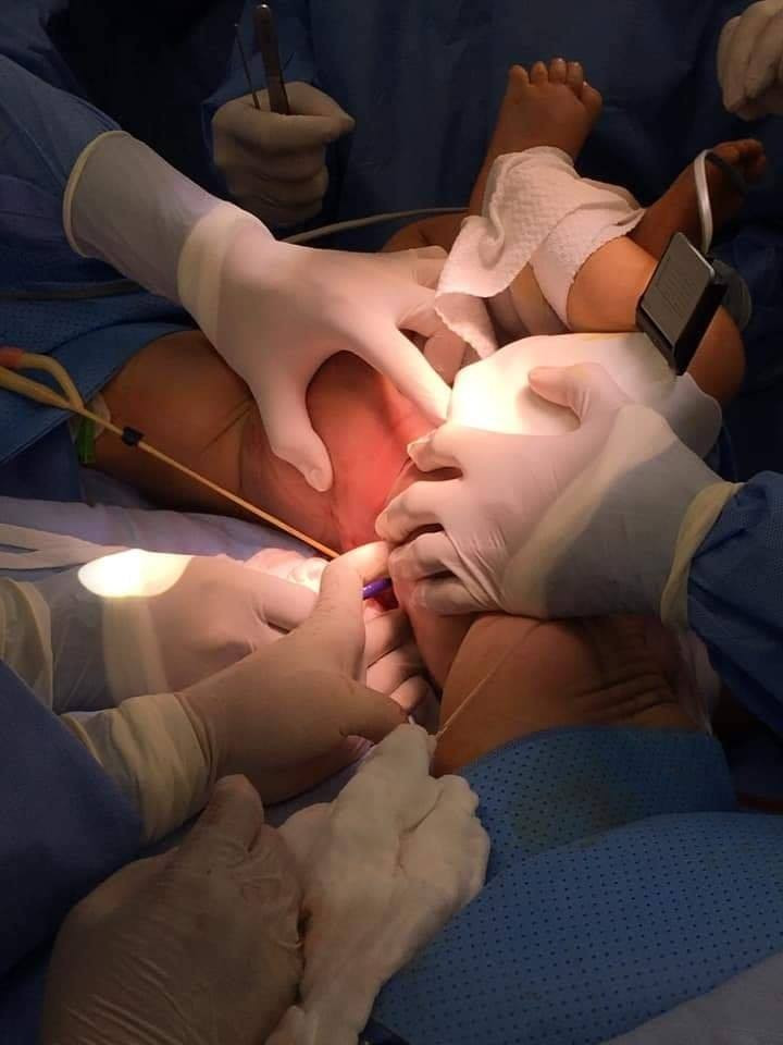 Khoảnh khắc tách dính hoàn toàn cho hai bé song sinh.