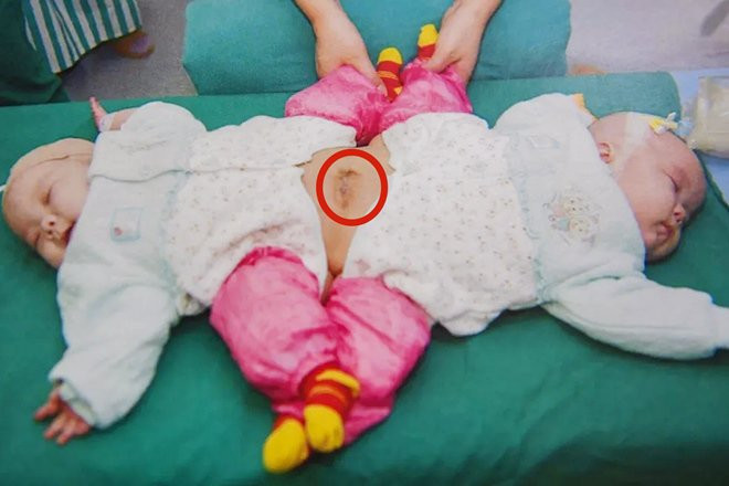 11 năm trước, vào tháng 6/2009, tại phòng sinh của thị trấn Vân Mộng, Hồ Bắc, Trung Quốc, người phụ nữ có tên Yang Wei đã hạ sinh một cặp con gái sinh đôi dính liền vào nhau từ rốn trở xuống, song mỗi bé vẫn có đủ 2 chân.