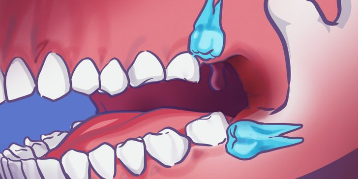 4. Răng khôn: Chắc hẳn nhiều người từng phải đau khổ vì chiếc răng này. Nhẹ thì ê ẩm, nặng thì đau nhức đến mức không ăn được gì và phải tới nhờ các nha sĩ giải quyết. Tuy nhiên, những chiếc răng này lại đóng một vai trò vô cùng to lớn đối với tổ tiên của chúng ta: giúp nghiền nát thức ăn. Ngày nay, răng khôn trở nên thừa thãi và nhiều khi phải đi nhổ bỏ.