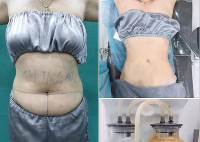 Trong phẫu thuật thẩm mỹ, việc hút mỡ tự thân nâng ngực khá phổ biến và hiệu quả mà kỹ thuật can thiệp lại không quá phức tạp. Tuy nhiên, nhiều bác sĩ đánh giá, kỹ thuật này nếu thực hiện không tốt dễ gây ra những biến chứng nguy hiểm.