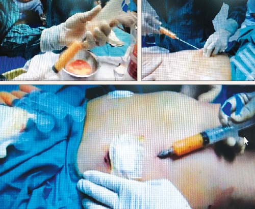 Trước khi tiến hành hút mỡ tự thân để nâng ngực, chị em cần được bác sĩ thăm khám. Đặc biệt, chị em cần thành thật với tiền sử bệnh lý, tránh những hậu quả đáng tiếc. Cụ thể, những người có bệnh lý mãn tính như tiểu đường, cao huyết áp, gan mật, giang mai, rối loạn đông máu… tuyệt đối không được hút mỡ tự thân để nâng ngực.