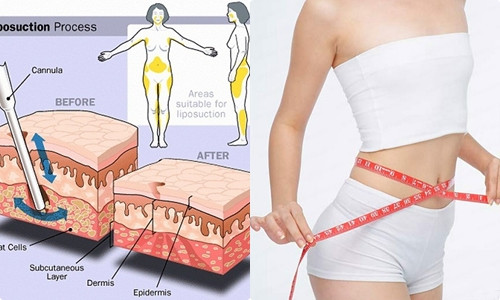 Ngoài ra, chuyên gia cũng đặc biệt nhấn mạnh, hút mỡ tự thân để nâng ngực cũng không cho kết quả lâu dài. Sau một thời gian ngắn, mỡ sẽ tự tiêu đến 80%. Điều này đòi hỏi bạn phải bơm bổ sung. Sau khi bổ sung cũng không đảm bảo tồn tại lâu dài. Do đó, trước khi quyết định hút mỡ tự thân để nâng ngực, chị em cần hết sức cẩn trọng và cân nhắc kỹ. Ảnh: Internet. Video "Bí quyết làm đẹp của sao Việt". Nguồn: VTC.