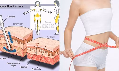 Ngoài ra, chuyên gia cũng đặc biệt nhấn mạnh, hút mỡ tự thân để nâng ngực cũng không cho kết quả lâu dài. Sau một thời gian ngắn, mỡ sẽ tự tiêu đến 80%. Điều này đòi hỏi bạn phải bơm bổ sung. Sau khi bổ sung cũng không đảm bảo tồn tại lâu dài. Do đó, trước khi quyết định hút mỡ tự thân để nâng ngực, chị em cần hết sức cẩn trọng và cân nhắc kỹ. Ảnh: Internet. Video "Bí quyết làm đẹp của sao Việt". Nguồn: VTC.