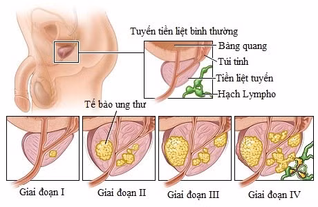 Benh ung thu cua nguyen Bo truong Vu Huy Hoang co nguy hiem?-Hinh-2