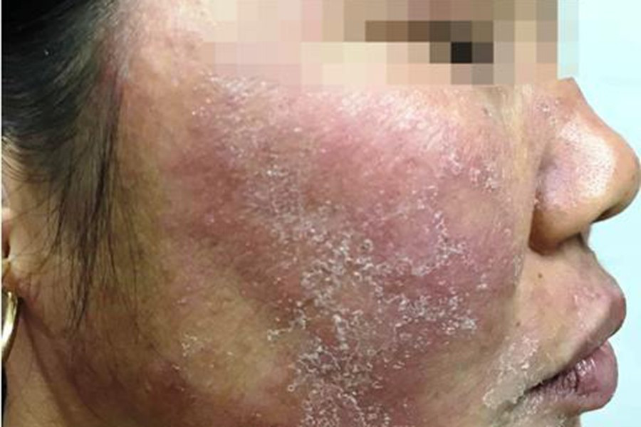 Khi có các biểu hiện bất thường da xảy ra do việc thoa, đắp sản phẩm nào đó, cần ngưng ngay và đến bệnh viện có chuyên khoa da liễu uy tín để chẩn đoán và điều trị kịp thời, tránh biến chứng nguy hiểm như viêm da tiếp xúc dị ứng, khiến làn da khó trở về tình trạng ban đầu. Ảnh minh họa: Internet. Video "Bí quyết làm đẹp của sao Việt". Nguồn: VTC.