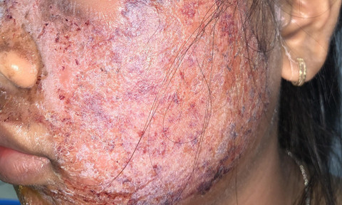 “Nhìn thấy hình ảnh da lột ra từng mảng lớn trắng như trứng gà, kèm với cam kêt trắng mịn không tỳ vết và giá thành rẻ, chỉ 65 ngàn đồng, nên em đã không ngần ngại mua về sử dụng với hy vọng da mình cũng sẽ trắng như vậy", thiếu nữ chia sẻ.