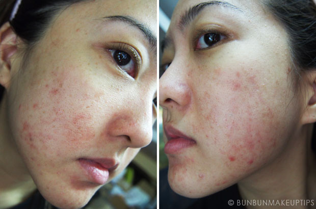 Qua đây, bác sĩ cũng khuyến cáo các chị em nên cẩn thận, lựa chọn phương pháp làm đẹp phù hợp, an toàn để tránh rước họa vào thân. Đặc biệt, không nên nghe lời đồn thổi, mua thuốc không rõ nguồn gốc để tắm trắng, tẩy da tại nhà.