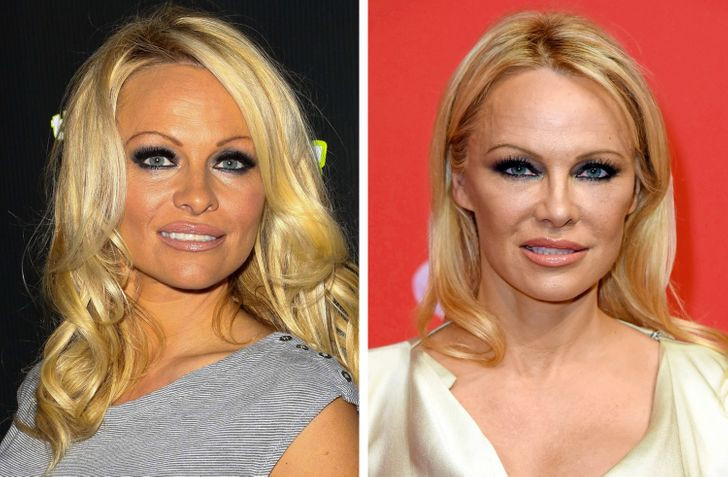 Đường viền chân mày bị hạ thấp: Khi chúng ta còn trẻ, độ căng của da tốt sẽ giữ chân mày cố định và không cho phép chúng "trượt" xuống. Nhưng theo tuổi tác, collagen duy trì độ đàn hồi và săn chắc của da không còn được sản sinh đều đặn nữa, các cơ mặt yếu đi và chảy sệ do tác động của trọng lực làm chúng ta có vẻ như lúc nào cũng nhăn nhó.