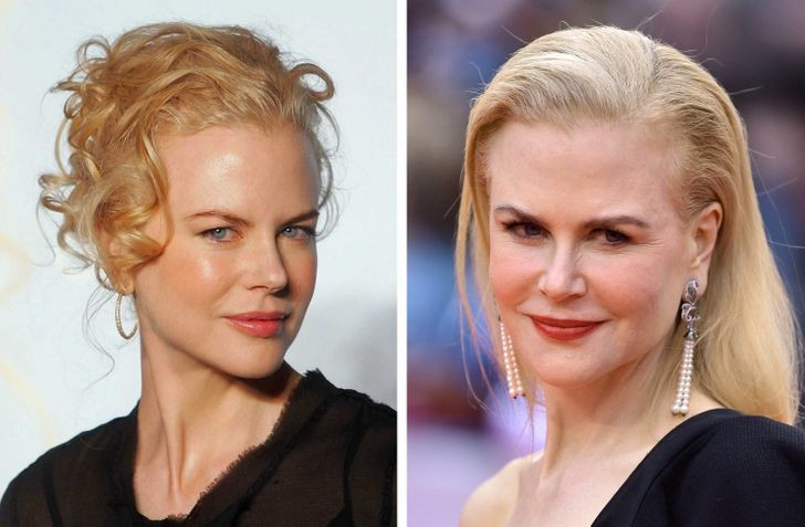 Trán bị bẹt: Tuổi tác có liên quan đế sự tiêu hao lượng mỡ dưới da. Điều này là kết quả của sự teo mô mỡ làm cho trán thay đổi hình dạng trong khi vẫn có thể khá mịn màng và không có nếp nhăn. Nhiều phụ nữ nghĩ rằng tiêm Botox sẽ mang lại vẻ căng tràn trên khuôn mặt nhưng điều đó chỉ làm dấu hiệu lão hóa này tồi tệ hơn.