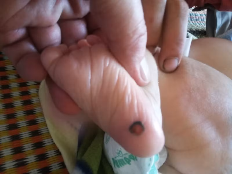 Soc: Be 1 thang tuoi da mac giang mai... nguyen nhan, cach phong ngua?