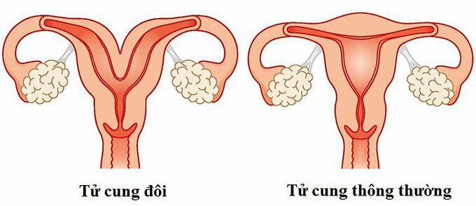 Hiếm gặp: Sản phụ 20 tuổi có 2 tử cung, sinh con nguy hiểm? - Hình 2 Hiem gap: San phu 20 tuoi co 2 tu cung, sinh con nguy hiem?-Hinh-2