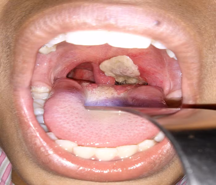 O dich bach hau tai Dak Nong: Bien chung “chet nguoi” va cach phong-Hinh-2