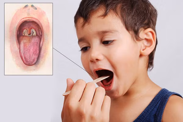 O dich bach hau tai Dak Nong: Bien chung “chet nguoi” va cach phong