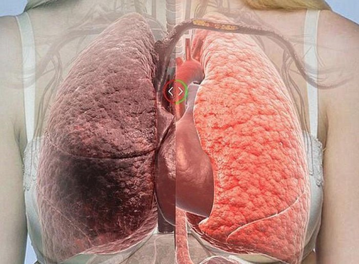 Nhạc sĩ Vũ Đức Sao Biển vừa qua đời sau 2 năm chiến đấu với căn bệnh ung thư phổi. Theo thống kê, mỗi năm trên thế giới có khoảng 2,09 triệu người mắc mới và 1,76 triệu người tử vong do ung thư phổi. Tại Việt Nam, mỗi năm có hơn 20.000 trường hợp tử vong vì bệnh ung thư phổi, đây thực sự là con số đáng báo động.