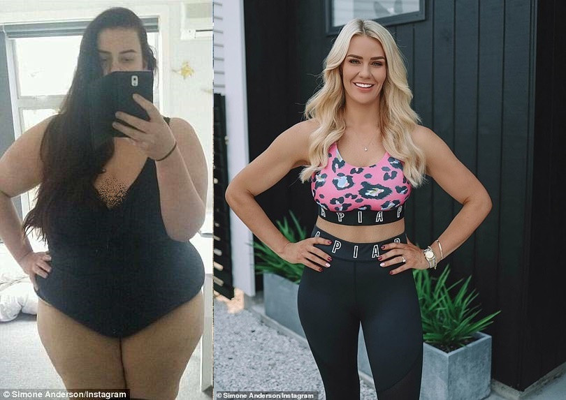 Do giảm nhiều cân, cô phải thực hiện phẫu thuật cắt bỏ những phần da thừa trên cơ thể.