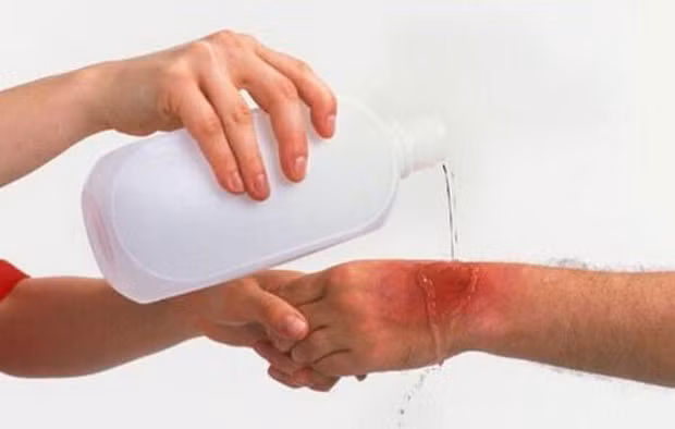 Bé gái bị bỏng nặng vì sứa “cắn”: Cách sơ cứu đúng cần biết - Hình 2 Be gai bi bong nang vi sua “can”: Cach so cuu dung can biet-Hinh-2