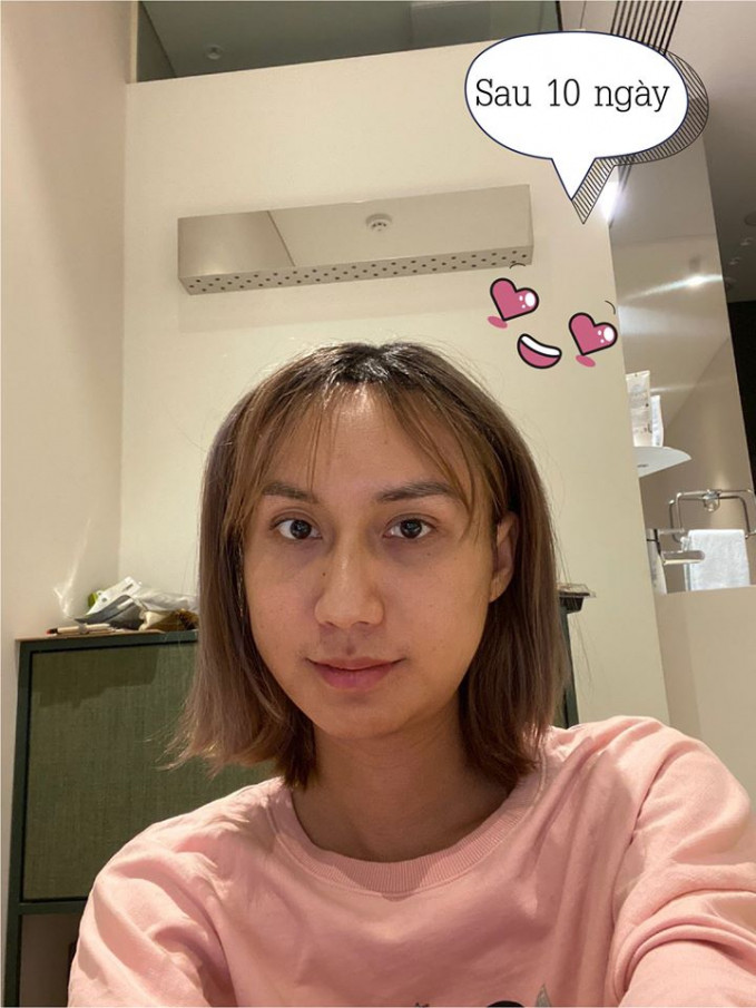 Linh nghĩ chắc do mình chuẩn bị tâm lý kĩ nên chịu được, hoặc đợi thuốc tê hết sẽ ngấm đau dần vì gọt hàm, cắt xương đủ kiểu cơ mà. Nhưng không, Linh lại lầm, đợi mãi mà vẫn chẳng đau.