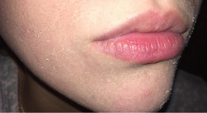 Da khô: Vitamin A là một trong các thành phần chính cơ thể cần để tái tạo tế bào da và giữ ẩm cho da. Dấu hiệu cơ thể thiếu vitamin A phổ biến là da khô có vảy, mẩn đỏ như bị thương tổn và ngứa.