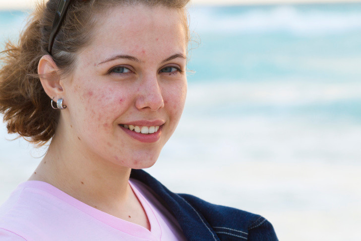 Mụn trứng cá: Vitamin A góp phần tái tạo tế bào da, do đó thiếu dưỡng chất này sẽ dẫn tới da khô. Điều này khiến da phải tiết nhiều dầu hơn, gây kích thích mụn trứng cá xuất hiện.